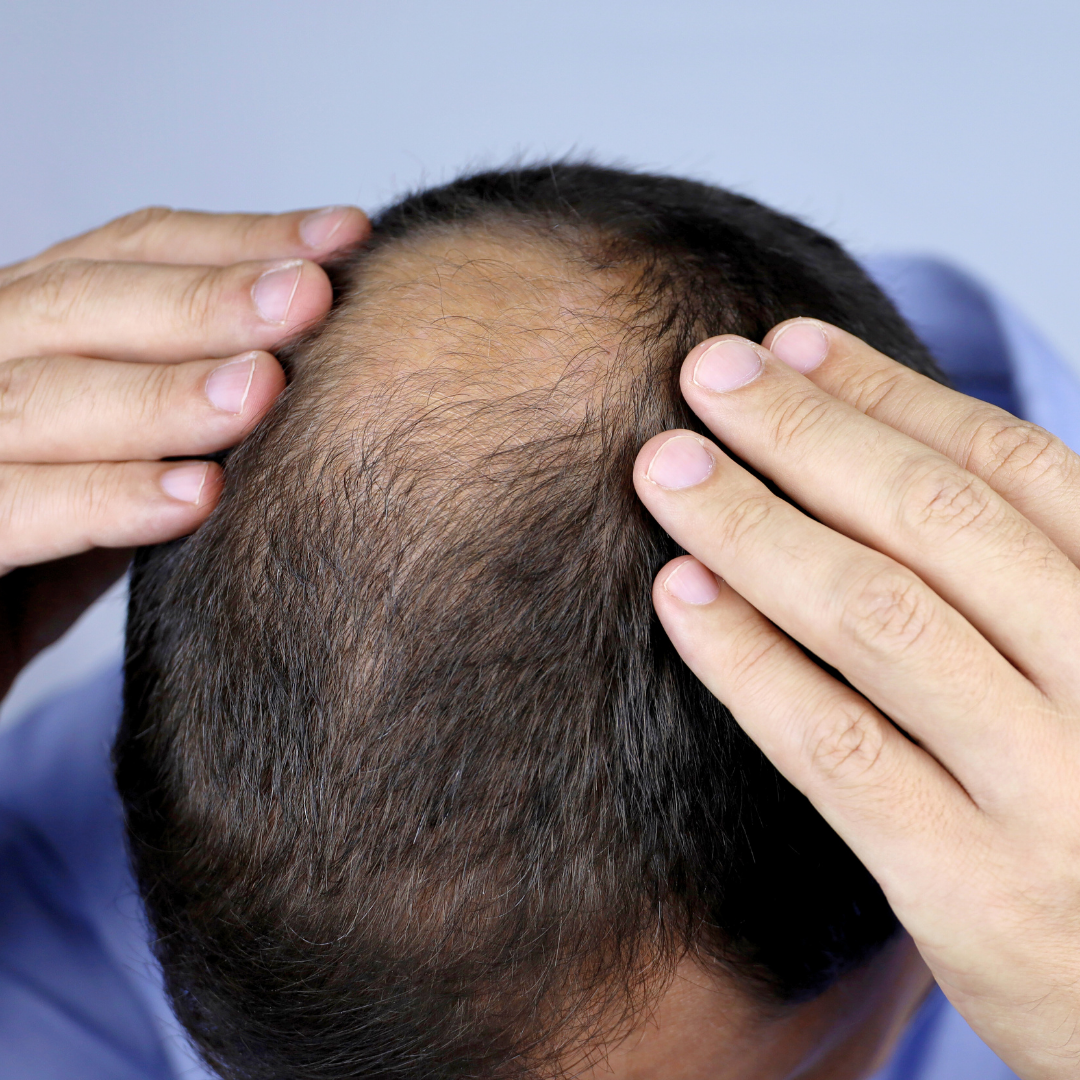 Hair Loss Treatment for Men Process